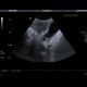Acute cholecystitis, pericholecystitic abscess: US - Ultrasound